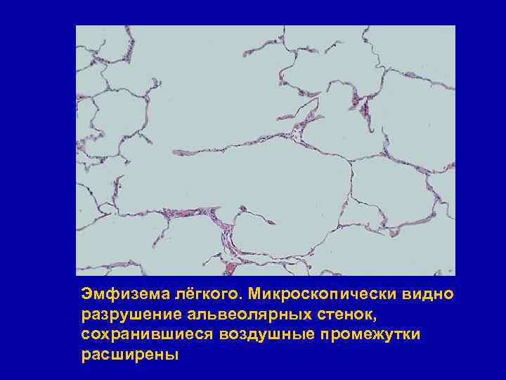 Эмфизема лёгкого. Микроскопически видно разрушение альвеолярных стенок, сохранившиеся воздушные промежутки расширены 