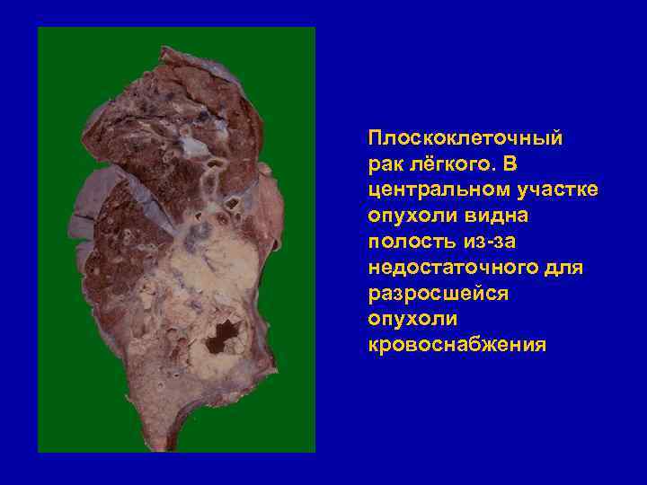 Плоскоклеточный рак лёгкого. В центральном участке опухоли видна полость из-за недостаточного для разросшейся опухоли