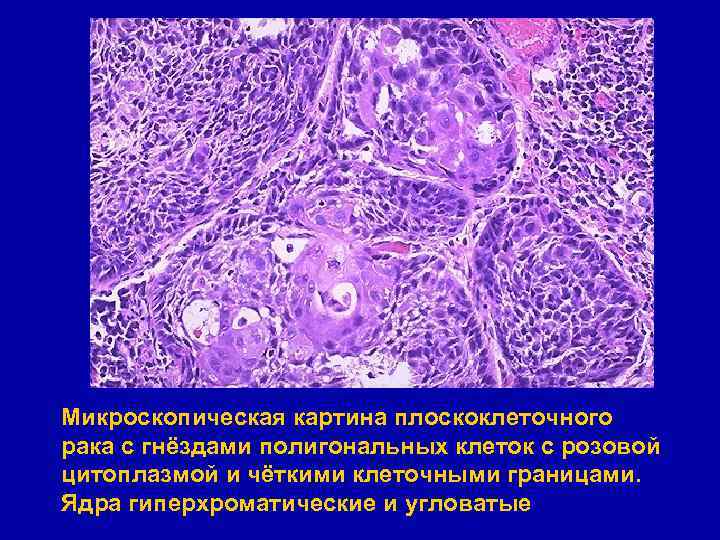 Микроскопическая картина плоскоклеточного рака с гнёздами полигональных клеток с розовой цитоплазмой и чёткими клеточными