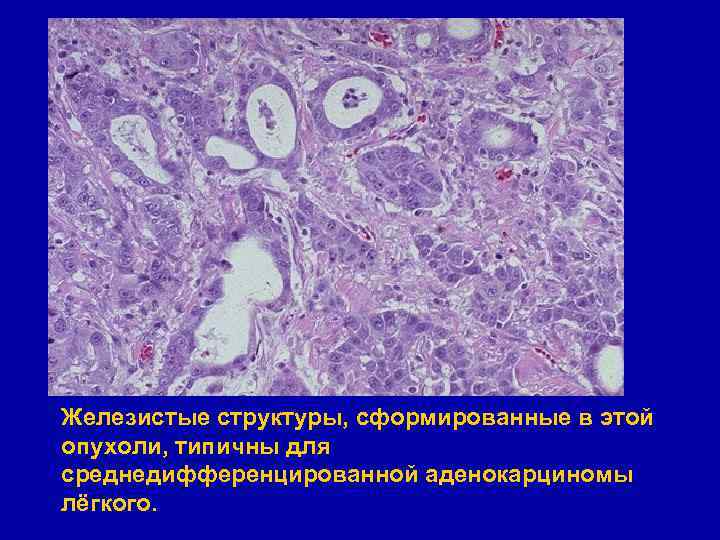 Железистые структуры, сформированные в этой опухоли, типичны для среднедифференцированной аденокарциномы лёгкого. 