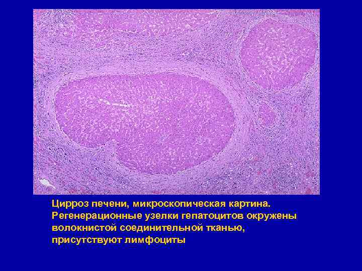Цирроз печени, микроскопическая картина. Регенерационные узелки гепатоцитов окружены волокнистой соединительной тканью, присутствуют лимфоциты 