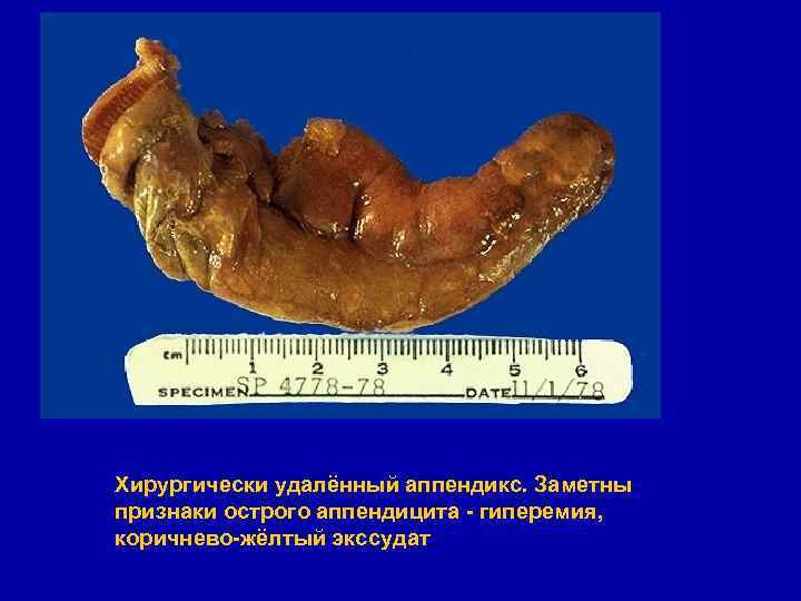 Хирургически удалённый аппендикс. Заметны признаки острого аппендицита - гиперемия, коричнево-жёлтый экссудат 
