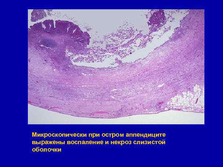 Микроскопически при остром аппендиците выражены воспаление и некроз слизистой оболочки 