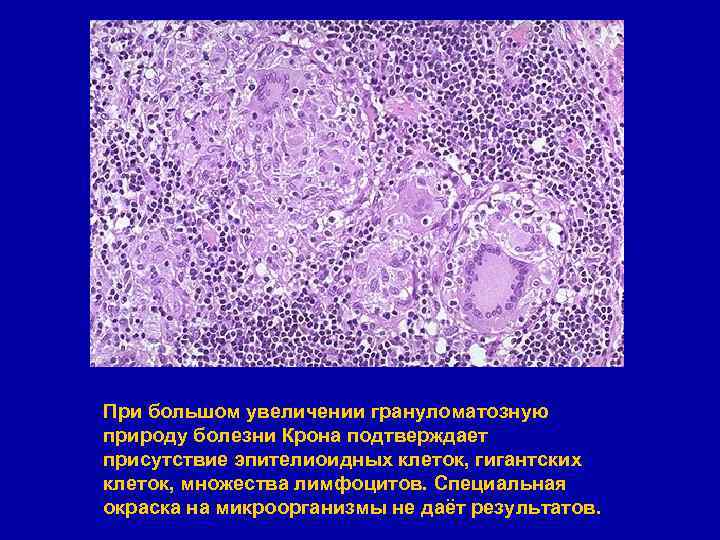 При большом увеличении грануломатозную природу болезни Крона подтверждает присутствие эпителиоидных клеток, гигантских клеток, множества