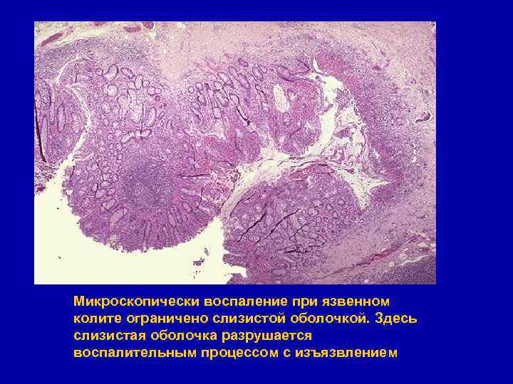 Микроскопически воспаление при язвенном колите ограничено слизистой оболочкой. Здесь слизистая оболочка разрушается воспалительным процессом