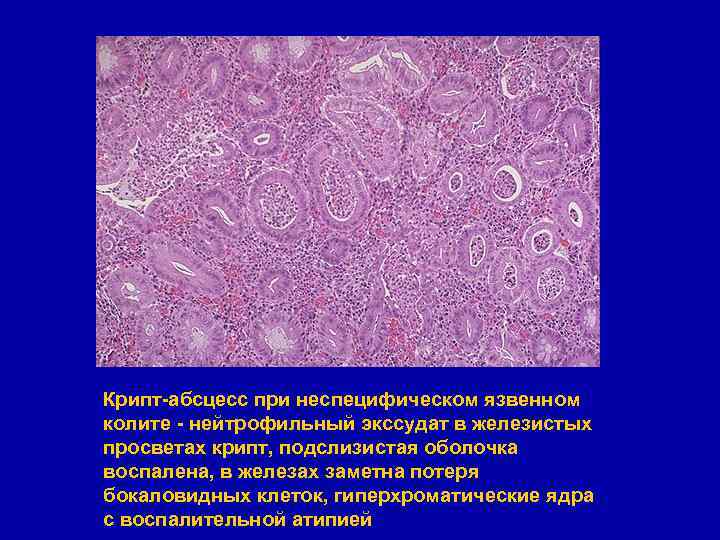 Крипт-абсцесс при неспецифическом язвенном колите - нейтрофильный экссудат в железистых просветах крипт, подслизистая оболочка