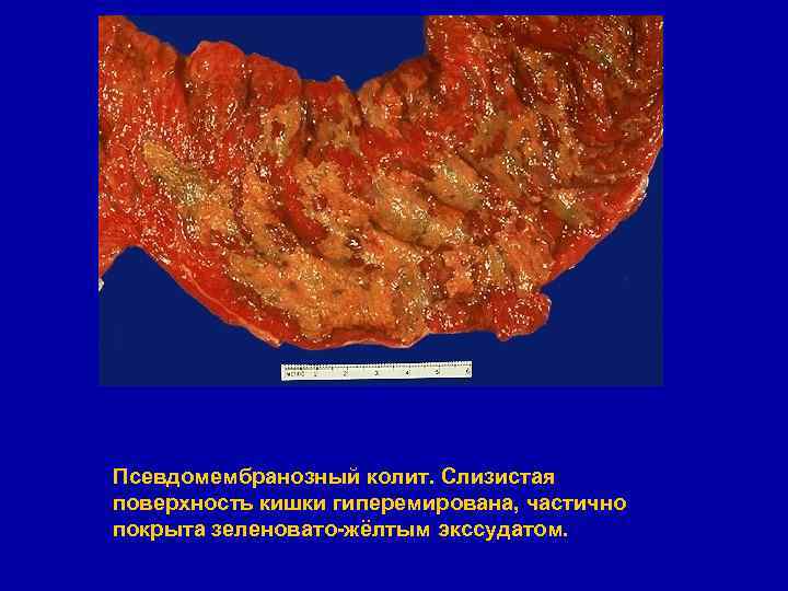 Псевдомембранозный колит. Слизистая поверхность кишки гиперемирована, частично покрыта зеленовато-жёлтым экссудатом. 