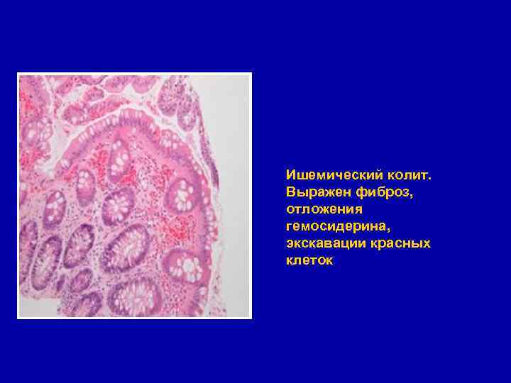 Ишемический колит. Выражен фиброз, отложения гемосидерина, экскавации красных клеток 