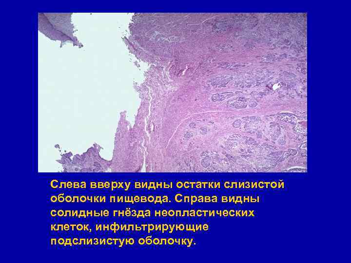 Слева вверху видны остатки слизистой оболочки пищевода. Справа видны солидные гнёзда неопластических клеток, инфильтрирующие