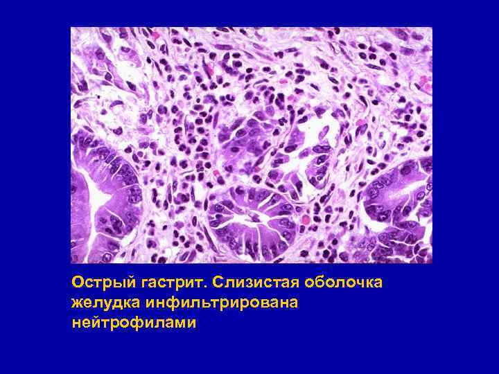 Острый гастрит. Слизистая оболочка желудка инфильтрирована нейтрофилами 