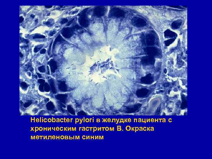Helicobacter pylori в желудке пациента с хроническим гастритом В. Окраска метиленовым синим 