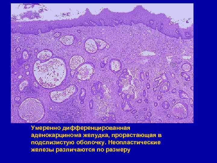 Умеренно дифференцированная аденокарцинома желудка, прорастающая в подслизистую оболочку. Неопластические железы различаются по размеру 