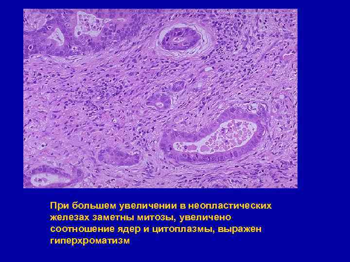 При большем увеличении в неопластических железах заметны митозы, увеличено соотношение ядер и цитоплазмы, выражен
