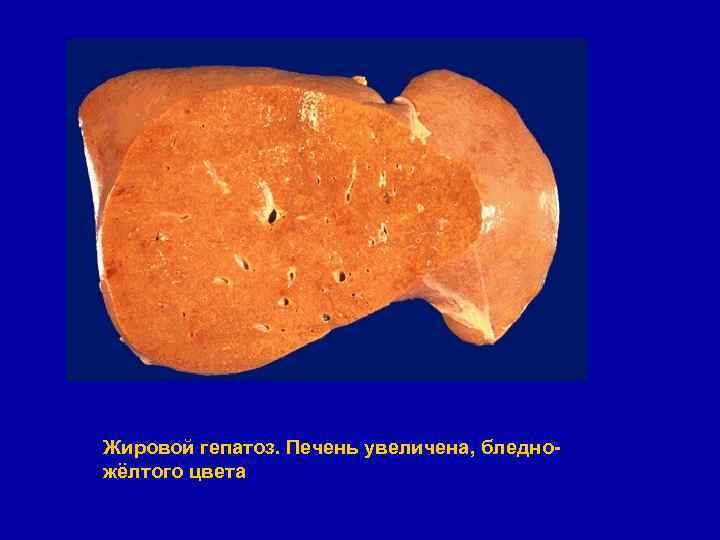 Жировой гепатоз. Печень увеличена, бледножёлтого цвета 