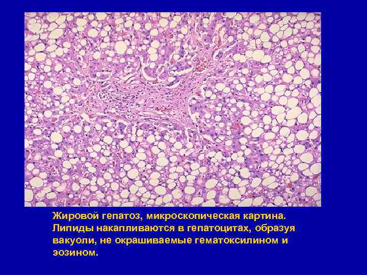 Жировой гепатоз, микроскопическая картина. Липиды накапливаются в гепатоцитах, образуя вакуоли, не окрашиваемые гематоксилином и