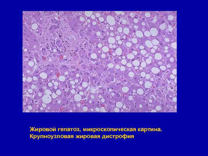 Жировой гепатоз, микроскопическая картина. Крупноузловая жировая дистрофия 