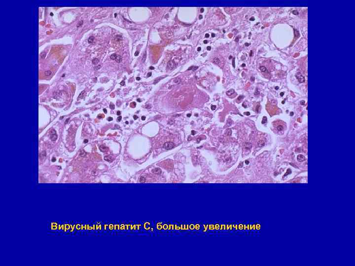 Вирусный гепатит С, большое увеличение 
