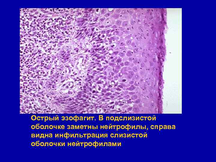 Острый эзофагит. В подслизистой оболочке заметны нейтрофилы, справа видна инфильтрация слизистой оболочки нейтрофилами 