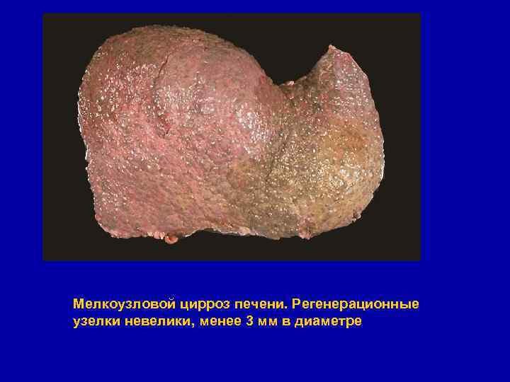 Мелкоузловой цирроз печени. Регенерационные узелки невелики, менее 3 мм в диаметре 