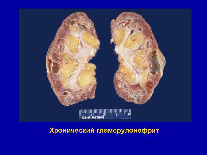 Гломерулонефрит хронический картинки