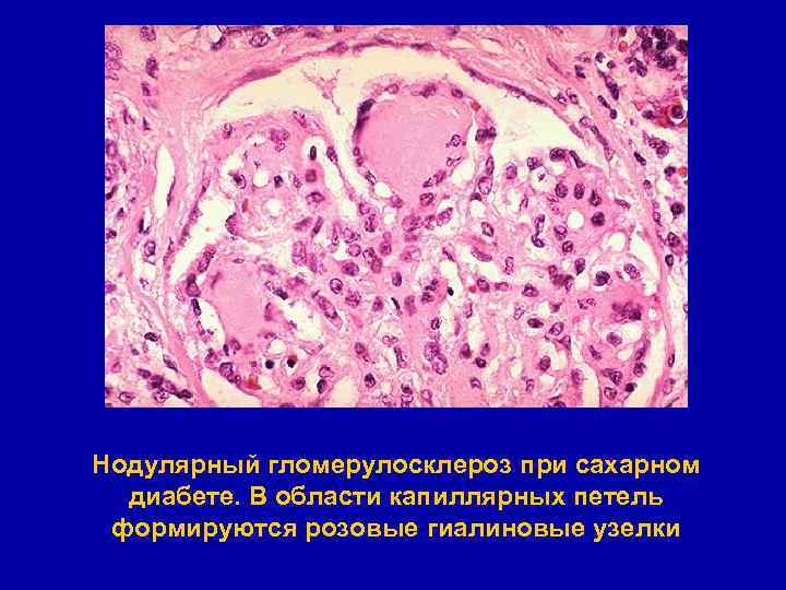 Сахарный диабет патанатомия презентация