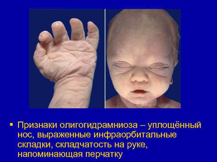 § Признаки олигогидрамниоза – уплощённый нос, выраженные инфраорбитальные складки, складчатость на руке, напоминающая перчатку