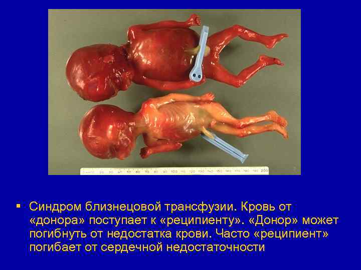 § Синдром близнецовой трансфузии. Кровь от «донора» поступает к «реципиенту» . «Донор» может погибнуть