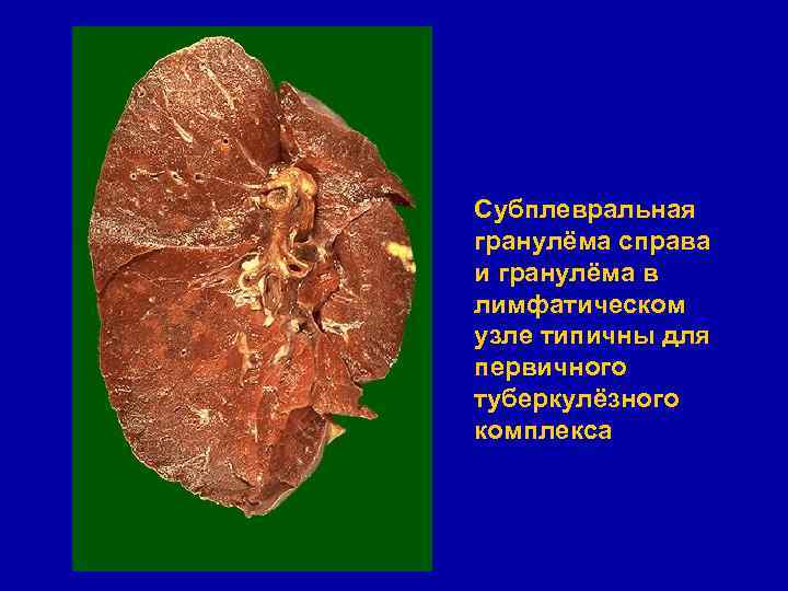 Субплевральная гранулёма справа и гранулёма в лимфатическом узле типичны для первичного туберкулёзного комплекса 