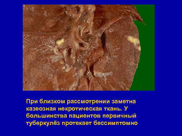 При близком рассмотрении заметна казеозная некротическая ткань. У большинства пациентов первичный туберкулёз протекает бессимптомно