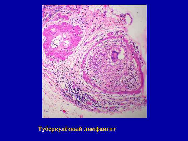 Туберкулёзный лимфангит 