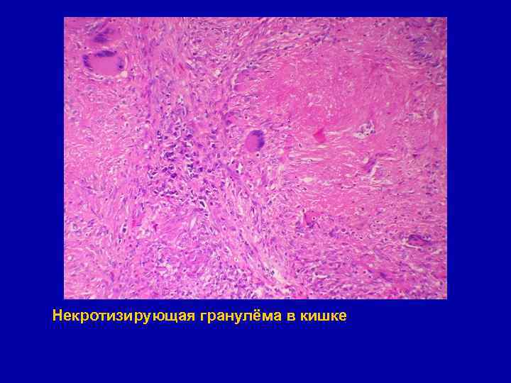 Некротизирующая гранулёма в кишке 