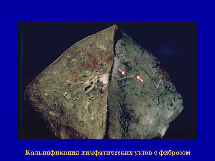 Обызвествление первичного аффекта (очаг Гона) Кальцификация лимфатических узлов с фиброзом 