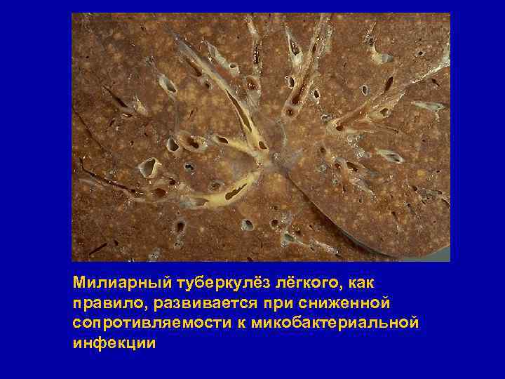 Милиарный туберкулёз лёгкого, как правило, развивается при сниженной сопротивляемости к микобактериальной инфекции 