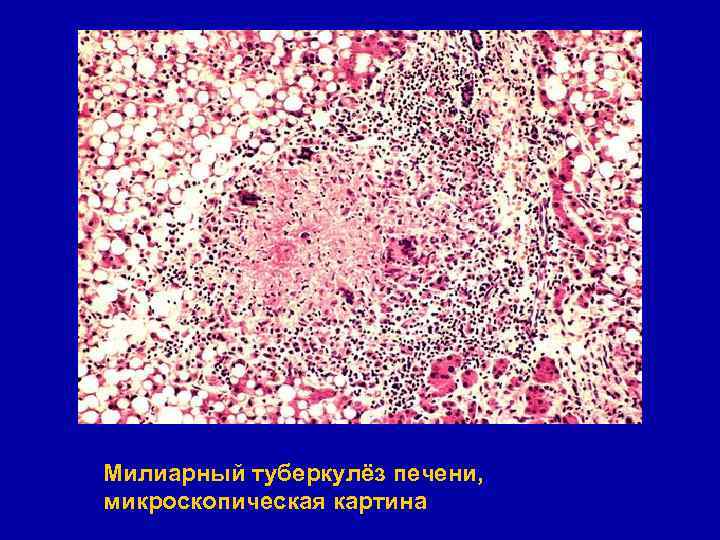 Милиарный туберкулёз печени, микроскопическая картина 