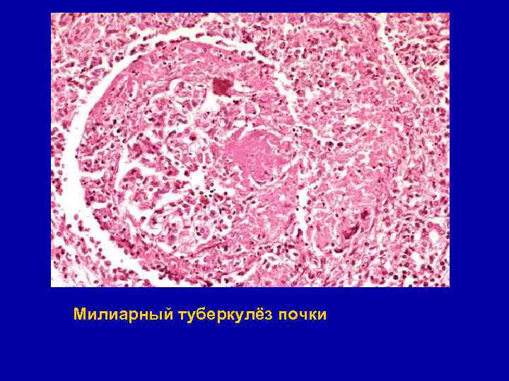 Милиарный туберкулёз почки 