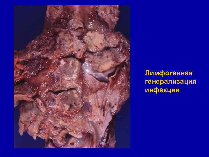 Лимфогенная генерализация инфекции 