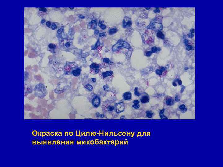 Окраска по Цилю-Нильсену для выявления микобактерий 