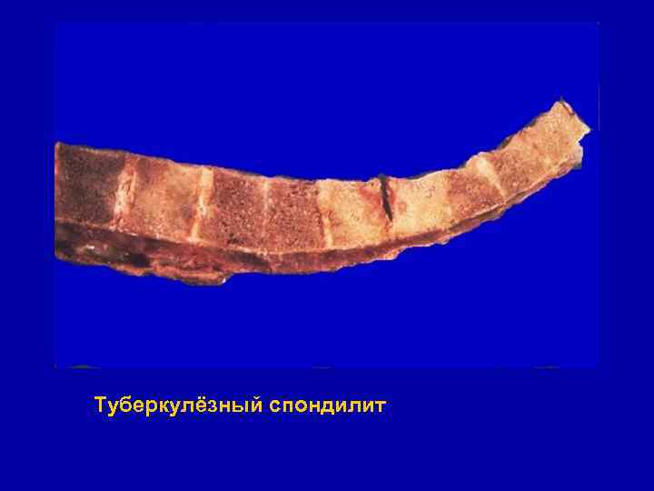 Туберкулёзный спондилит 