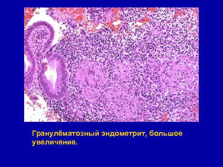 Гранулёматозный эндометрит, большое увеличение. 