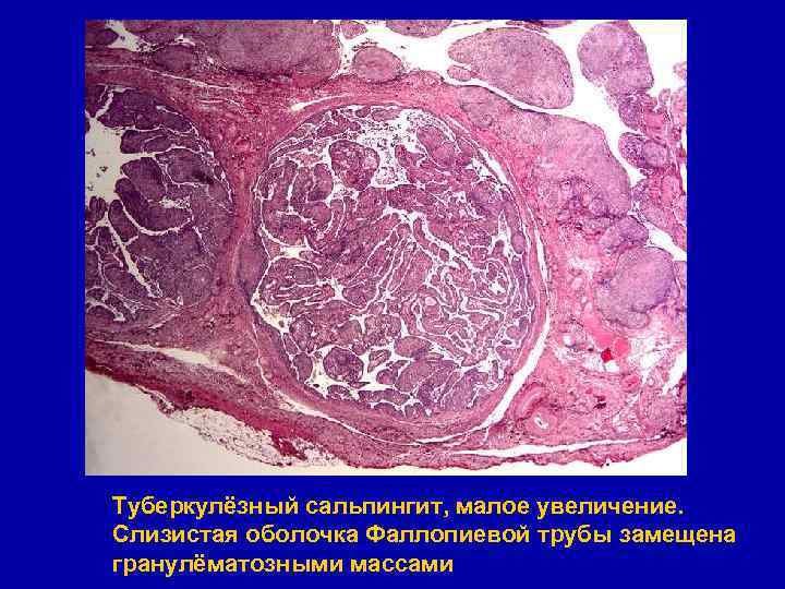 Туберкулёзный сальпингит, малое увеличение. Слизистая оболочка Фаллопиевой трубы замещена гранулёматозными массами 