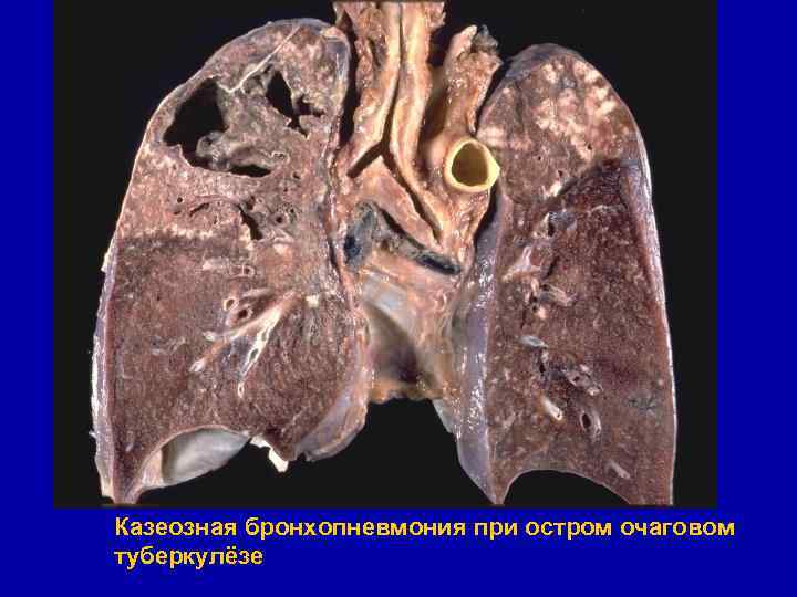 Казеозная бронхопневмония при остром очаговом туберкулёзе 