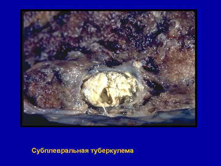 Субплевральная туберкулема 