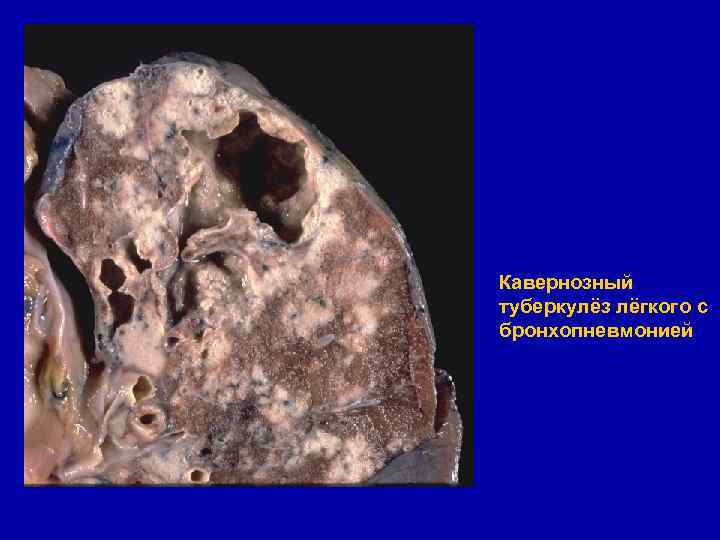 Кавернозный туберкулёз лёгкого с бронхопневмонией 