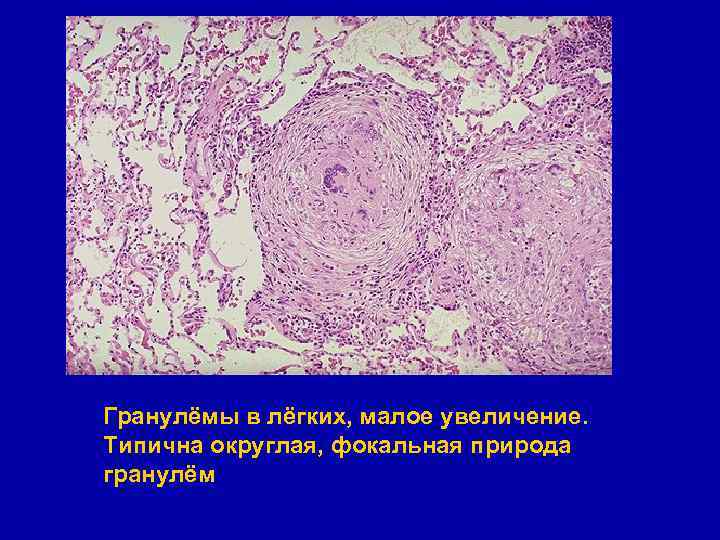 Гранулёмы в лёгких, малое увеличение. Типична округлая, фокальная природа гранулём 