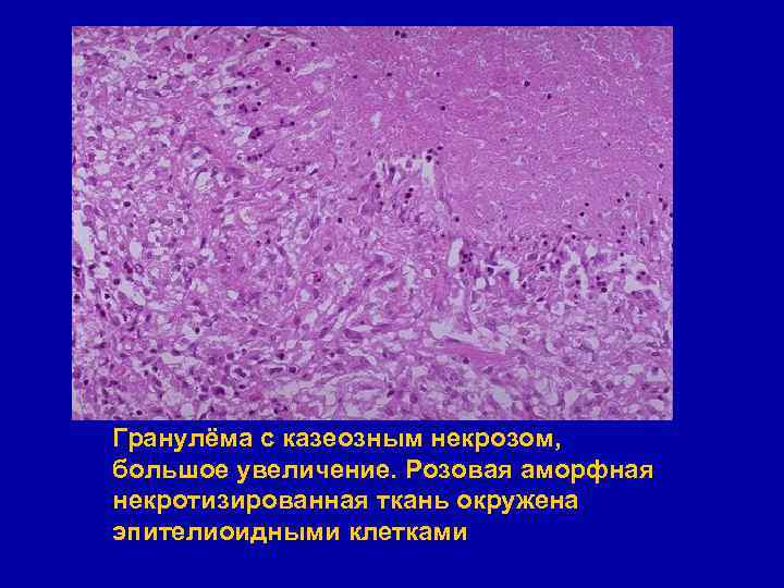 Гранулёма с казеозным некрозом, большое увеличение. Розовая аморфная некротизированная ткань окружена эпителиоидными клетками 
