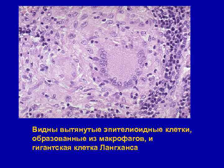 Видны вытянутые эпителиоидные клетки, образованные из макрофагов, и гигантская клетка Лангханса 