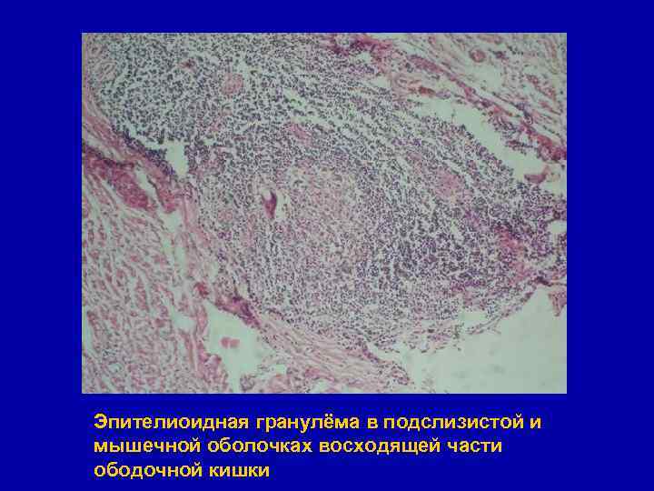 Эпителиоидная гранулёма в подслизистой и мышечной оболочках восходящей части ободочной кишки 