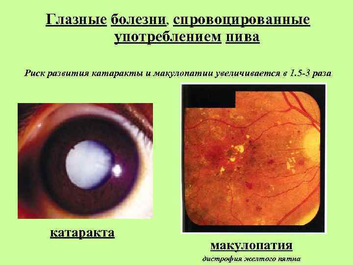 Глазные болезни, спровоцированные употреблением пива Риск развития катаракты и макулопатии увеличивается в 1. 5