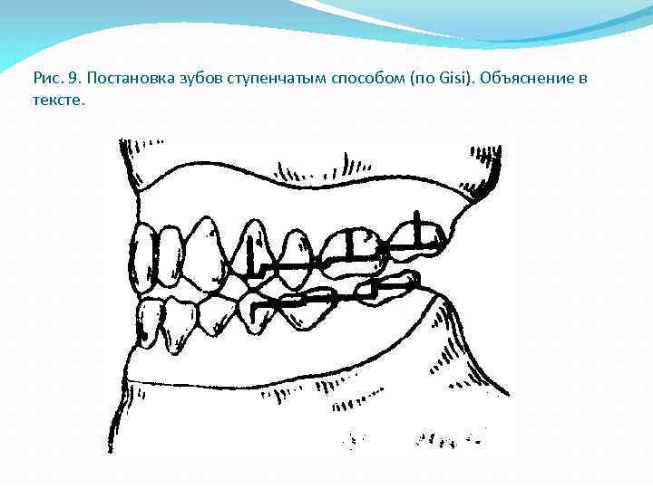 Постановка искусственных зубов по васильеву презентация