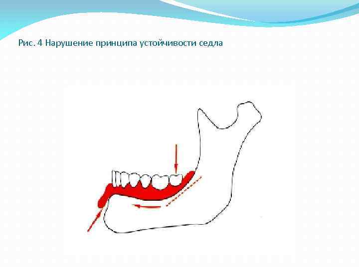 Рис. 4 Нарушение принципа устойчивости седла 